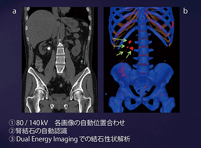 図7　症例2：120kV相当の混合画像（a）とsyngo. viaによる結石の自動認識結果（b）