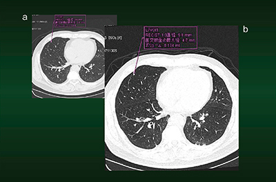 図4　症例3：Auto Segmentationによる病変の測定・認識