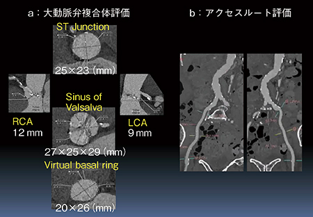 図5　大動脈弁複合体およびデバイスアクセスルートの評価