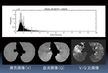 図6　位置合わせ不良例のV/Q比画像とV/Q比ヒストグラム（59歳，女性，肺腺癌症例）