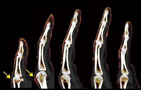 図4　症例2：全指に対する各矢状断の再構成