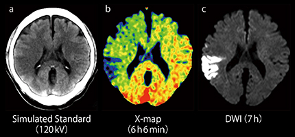 図4　図3と同症例における120kV相当のCT画像，X-map，DWIの比較 X-map（b）ではearly CT signが明瞭である。