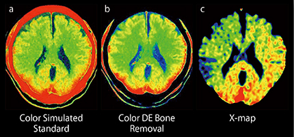 図5　カラーリングした120kV相当のCTの画像およびDE Bone Removal画像とX-mapの比較