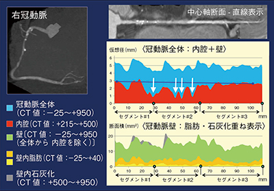 図4　NCVCシステムでの内腔仮想径と壁厚，壁と壁内脂質および石灰化の断面積の表示