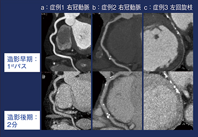 図5　日生病院方式での冠動脈壁の性状評価