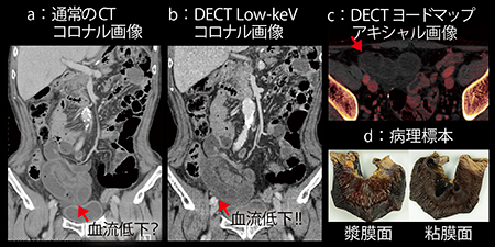 図2　症例2：絞扼性イレウスによる腸管虚血（76歳，男性）