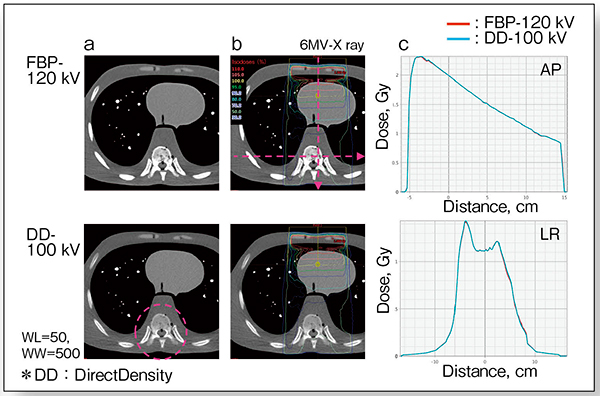 図6　DirectDensityの評価（胸部ファントム）
