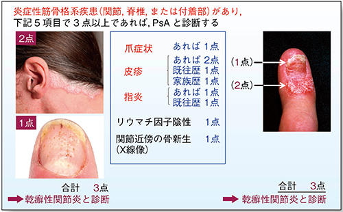 図1　乾癬性関節炎の分類基準“CASPAR” 感度91.4%，特異度98.7%