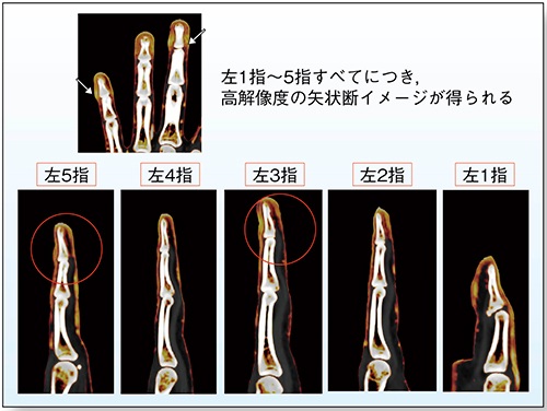 図2　左1指〜5指のDECTヨードマップの矢状断像
