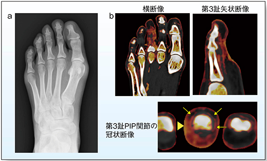 図4　症例1：PsA（24歳，女性，乾癬歴14年） a：単純X線写真 b：DECTのヨードマップ画像