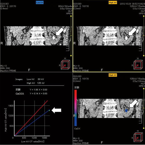 図2　放射線非透過性結石例（矢印：20mm大の左下腎杯結石） 低電圧（80kV）でのCT値は高電圧（135kV）より大きく、尿酸結石とは明らかに異なるパターンを示した。結石分析の結果は、シュウ酸カルシウムであった。