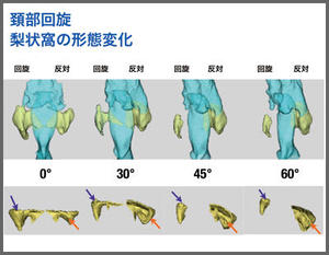 図12　頸部回旋による梨状窩の形態変化