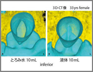 図16　とろみ水と液体の嚥下の声帯動態の比較