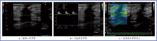 図17　乳頭腺管癌