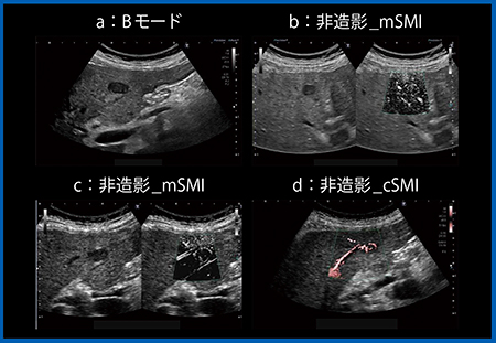 図2　症例1：Bモード画像（a）および非造影SMI（b〜d）