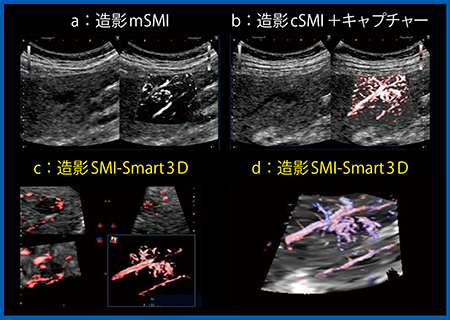 図5　症例1：新しい造影SMI