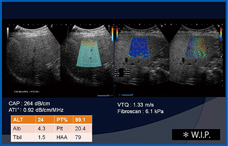 図11　症例4：NASHにおける脂肪の減衰および肝線維化の測定