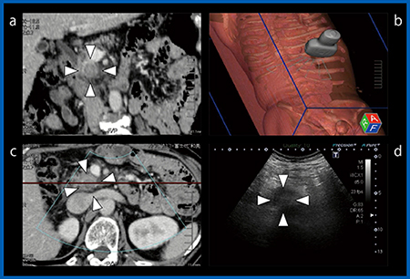 図1　MPR-CT vs. US Fusion Imaging