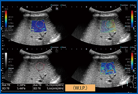 図9　慢性肝炎のDispersion Imaging