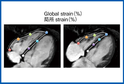 図2　右室長軸ストレイン解析