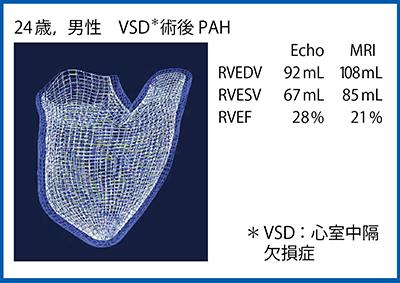 図4　3D RV Speckle trackingによる右室容量計測