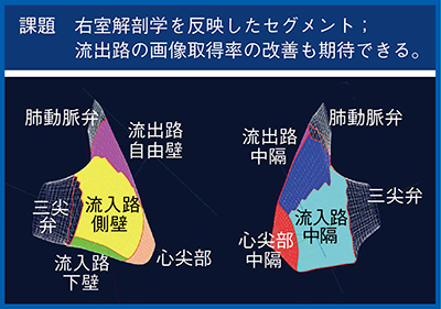 図7　右室解剖学を反映したセグメント化