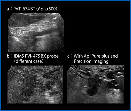 図3　膵臓がんにおけるPVT-674BT（a）とiDMS PVI-475BX（b，ｃ）の比較