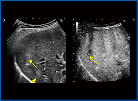 図4　HCCと肝血管腫における従来プローブ（a）とiDMS PVI-475BX（b）の比較