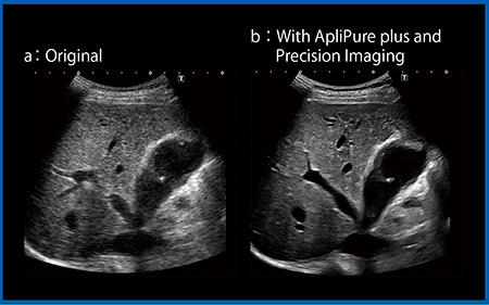 図5　ApliPure plusとPrecision Imagingによるスペックルノイズの低減