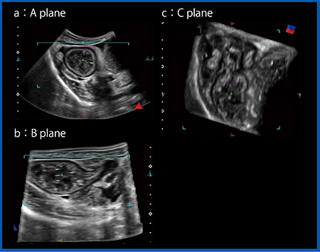 図14　悪性リンパ腫を先進部とする腸重積におけるC plane（c）の有用性