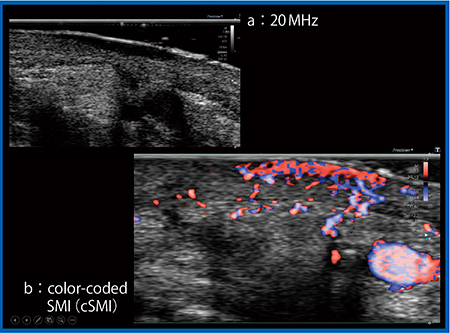 図16　iDMS PLI-2004BX（20MHz）による悪性黒色腫の描出