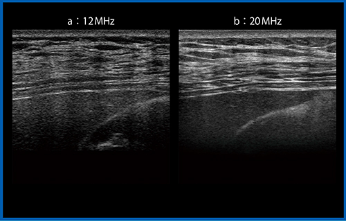 図19　胃がんにおける12MHzプローブ（a）とiDMS PLI-2004BX（20MHz）（b）の比較