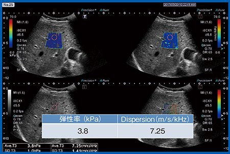 図8　症例1：正常肝の弾性率とDispersion slope Plt 30.9万，AST 19，ALT 13，T-Bil 0.40