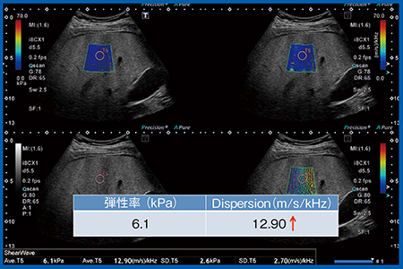 図9　症例2：NASH症例の弾性率とDispersion slope Plt 24.8万，AST 78，ALT 172，T-Bil 0.42