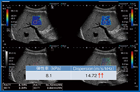 図10　症例3：急性A型肝炎症例の弾性率とDispersion slope Plt 13.4万，AST 6760，ALT 7698，T-Bil 4.59