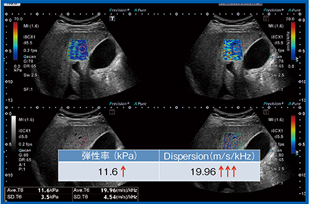 図11　症例4：NASH LC症例の弾性率とDispersion slope Plt 4.6万，AST 48，ALT 49，T-Bil 1.10