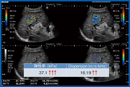 図12　症例5：C型肝硬変症例の弾性率とDispersion slope Plt 11.3万，AST 85，ALT 62，T-Bil 0.94
