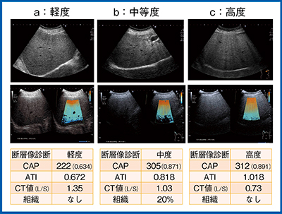 図6　ATIによる肝脂肪化の診断