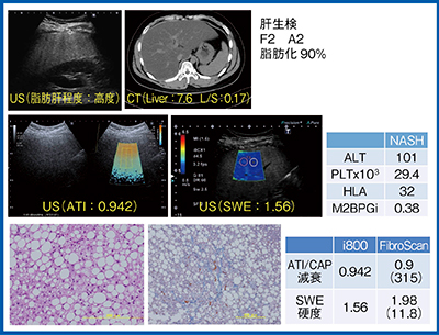 図8　症例1：潰瘍性大腸炎を有するNASH症例（20歳代前半，男性）