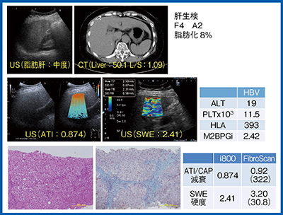図9　症例2：Burn out NASH症例（60歳代，女性）