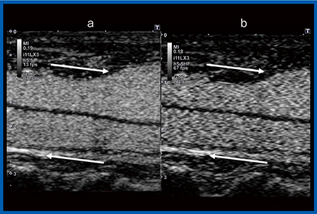 図1　総頸動脈と内頸静脈の造影超音波 a：Original CHI　b：HFR-CHI