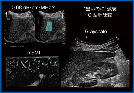 図4　低エコー領域の後方が減衰する例（C型肝硬変）
