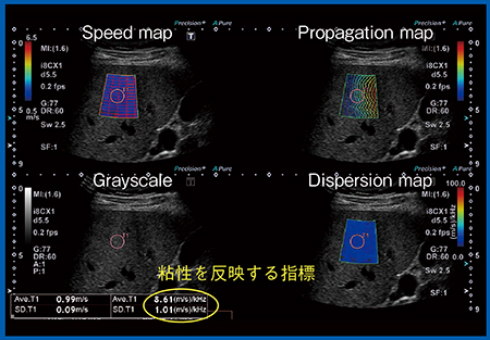 図5　Shear Wave Dispersion（SWD） 正常肝のshear wave elasticityとDispersion