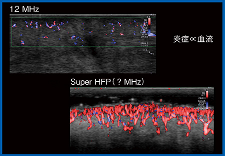 図13　毛囊炎のSMI a：Conventional High Frequency Probe（12MHz） b：Super High Frequency Probe