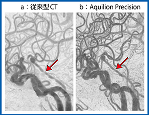 図1　脳底動脈狭窄症例