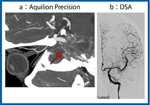 図5　血管外皮細胞腫の術前評価（DSAとの比較）