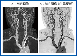 図7　Aquilion Precisionによる重度の内頸動脈狭窄と動脈硬化の症例の画像