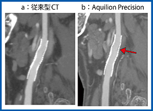図8　頸部血管ステント留置症例のフォローアップ