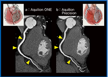 図1　症例1：狭心症症例における右冠動脈の描出能の比較