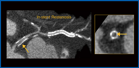 図4　症例3：Aquilion Precisionによるステント内再狭窄の描出